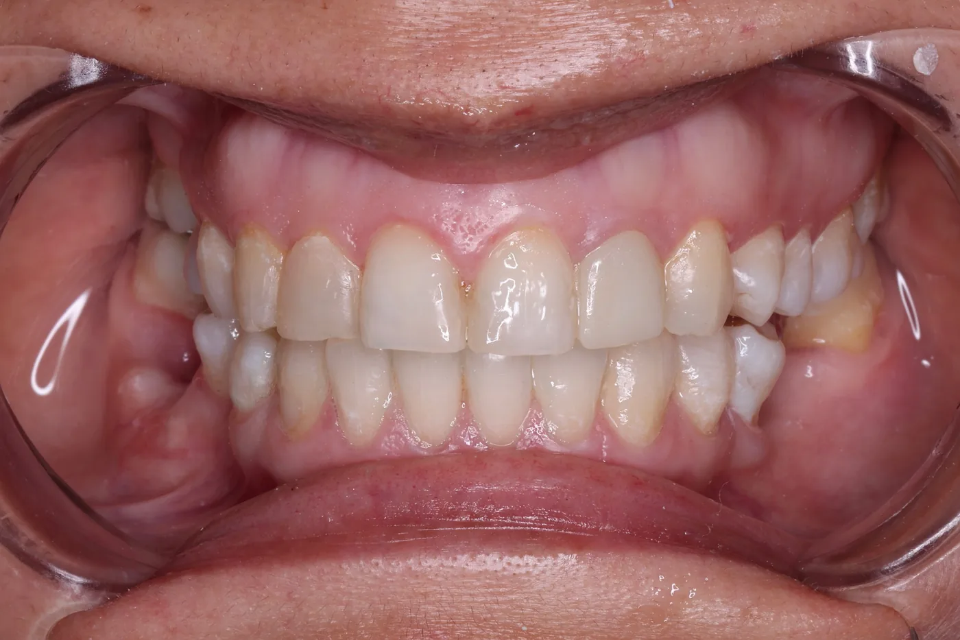 Los mismos dientes con un tono más blanco y menos amarillento después del blanqueamiento