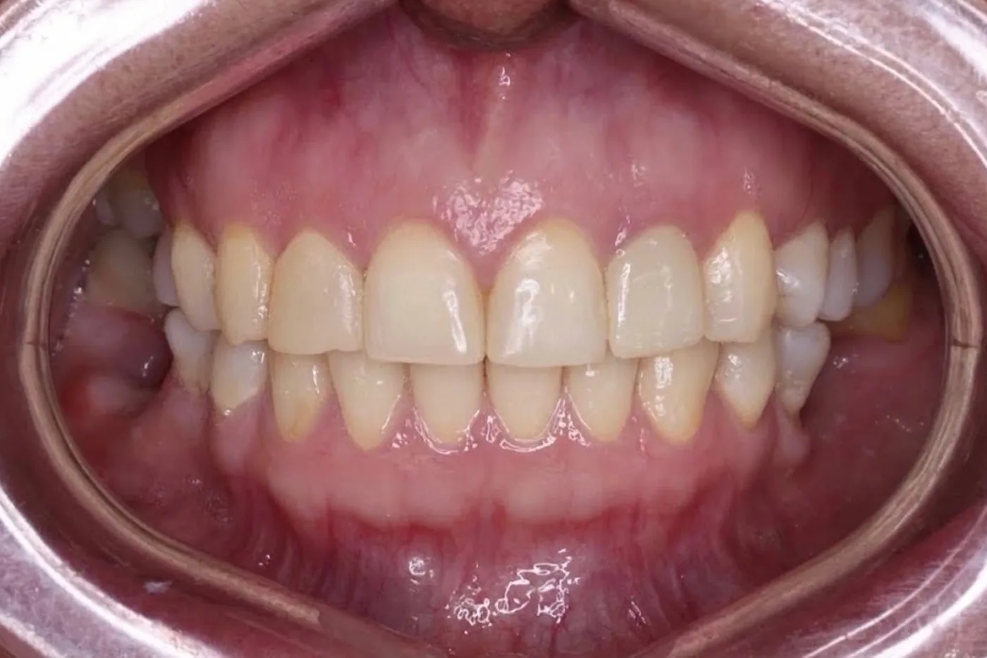 Dientes de un paciente con un tono amarillento antes del blanqueamiento